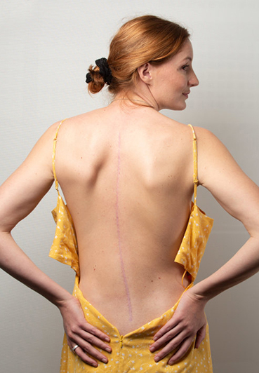 Post surgery photo_369x532